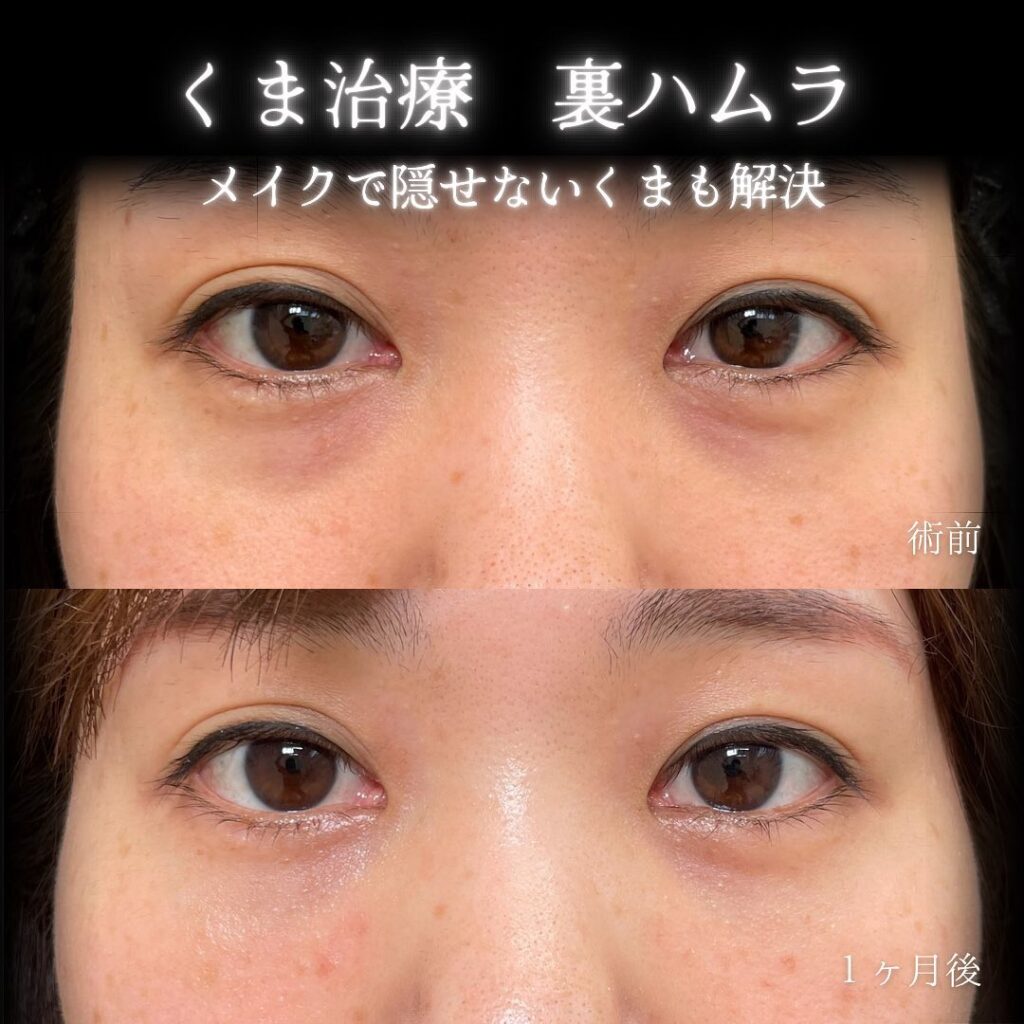 eクリニック大阪梅田西日本統括院の裏ハムラの症例画像(4)