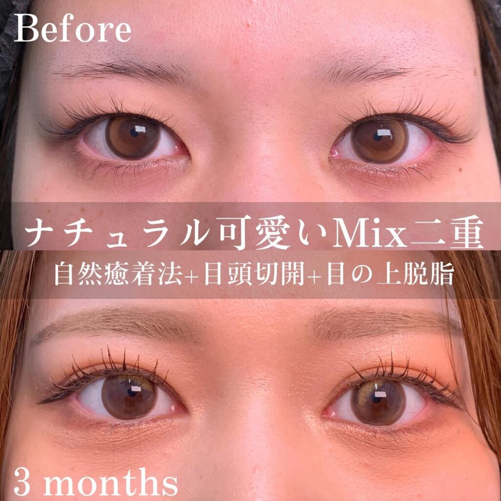 自然癒着法と目頭切開と目の上の脱脂の症例写真