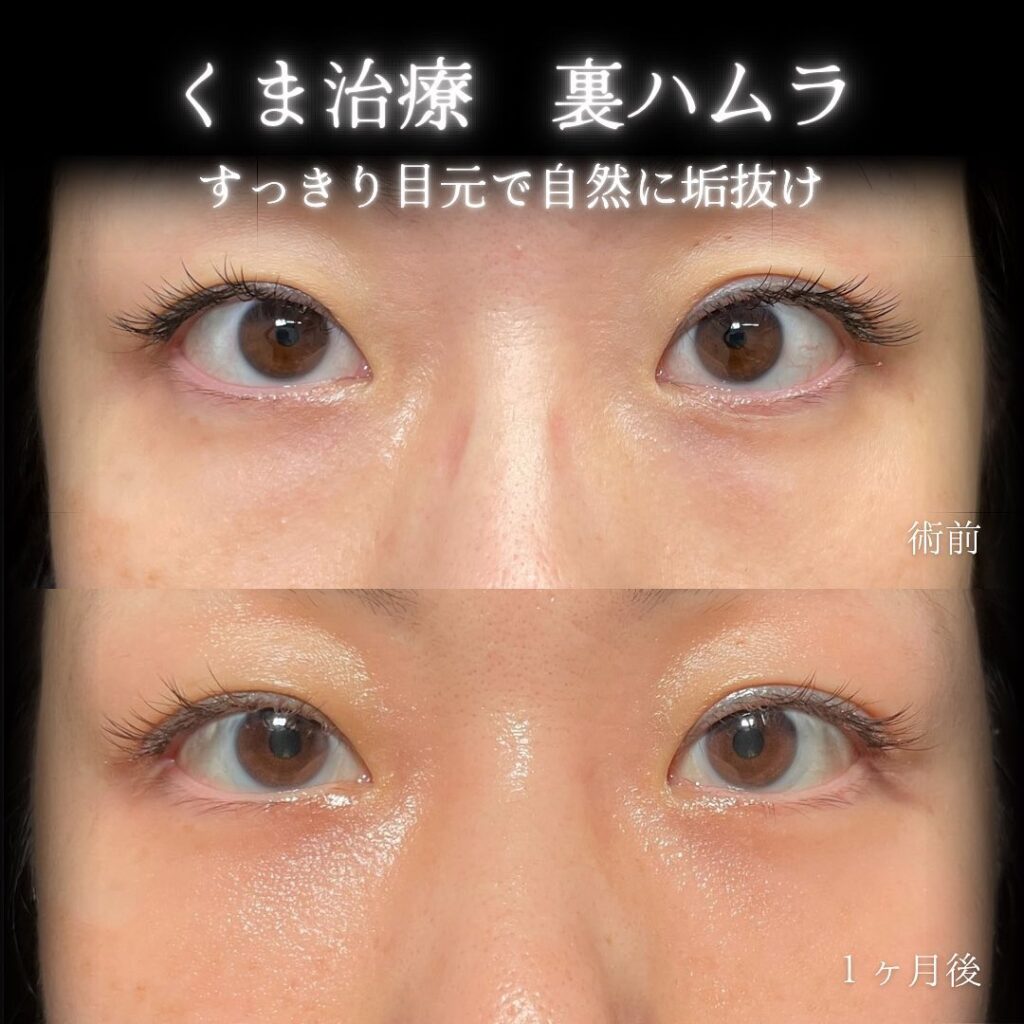 eクリニック大阪梅田西日本統括院の裏ハムラの症例画像(5)