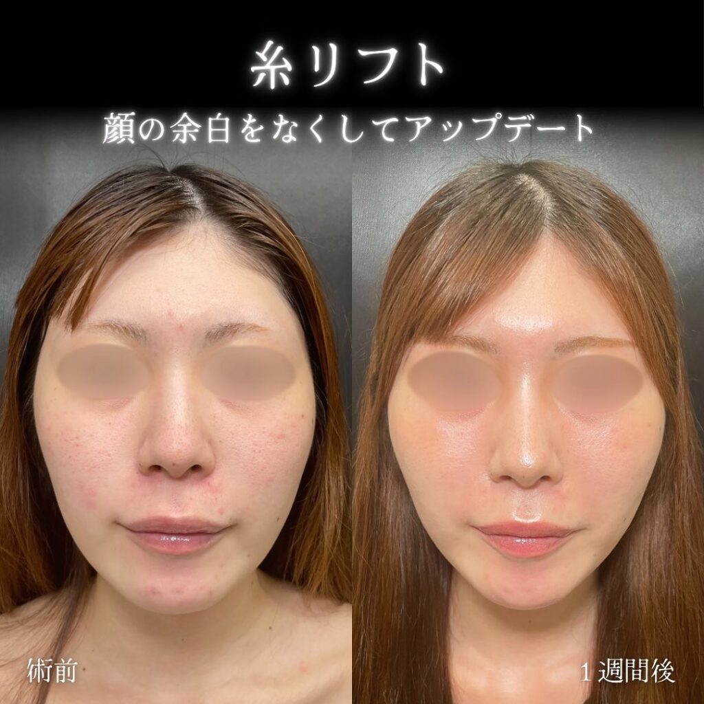 eクリニック大阪梅田院の糸リフトの症例写真（名医の脇谷雄一朗医師が執刀）