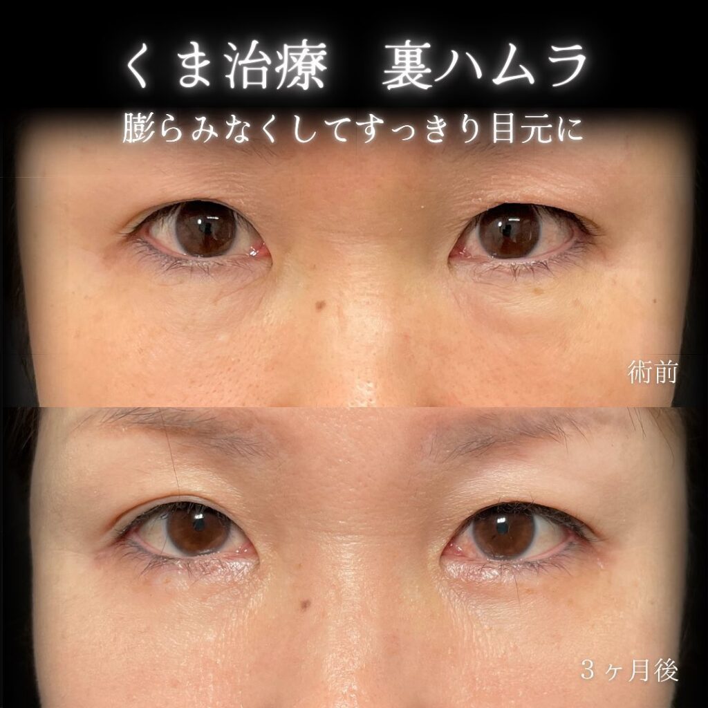 eクリニック大阪梅田西日本統括院の裏ハムラの症例画像(6)