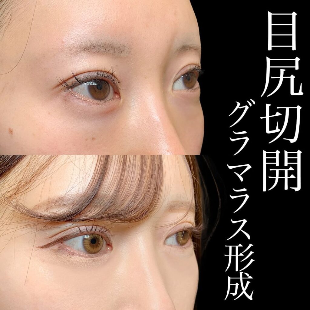 タレ目形成・グラマラスライン形成＋目尻切開の症例写真
（名医の円戸望医師が執刀）