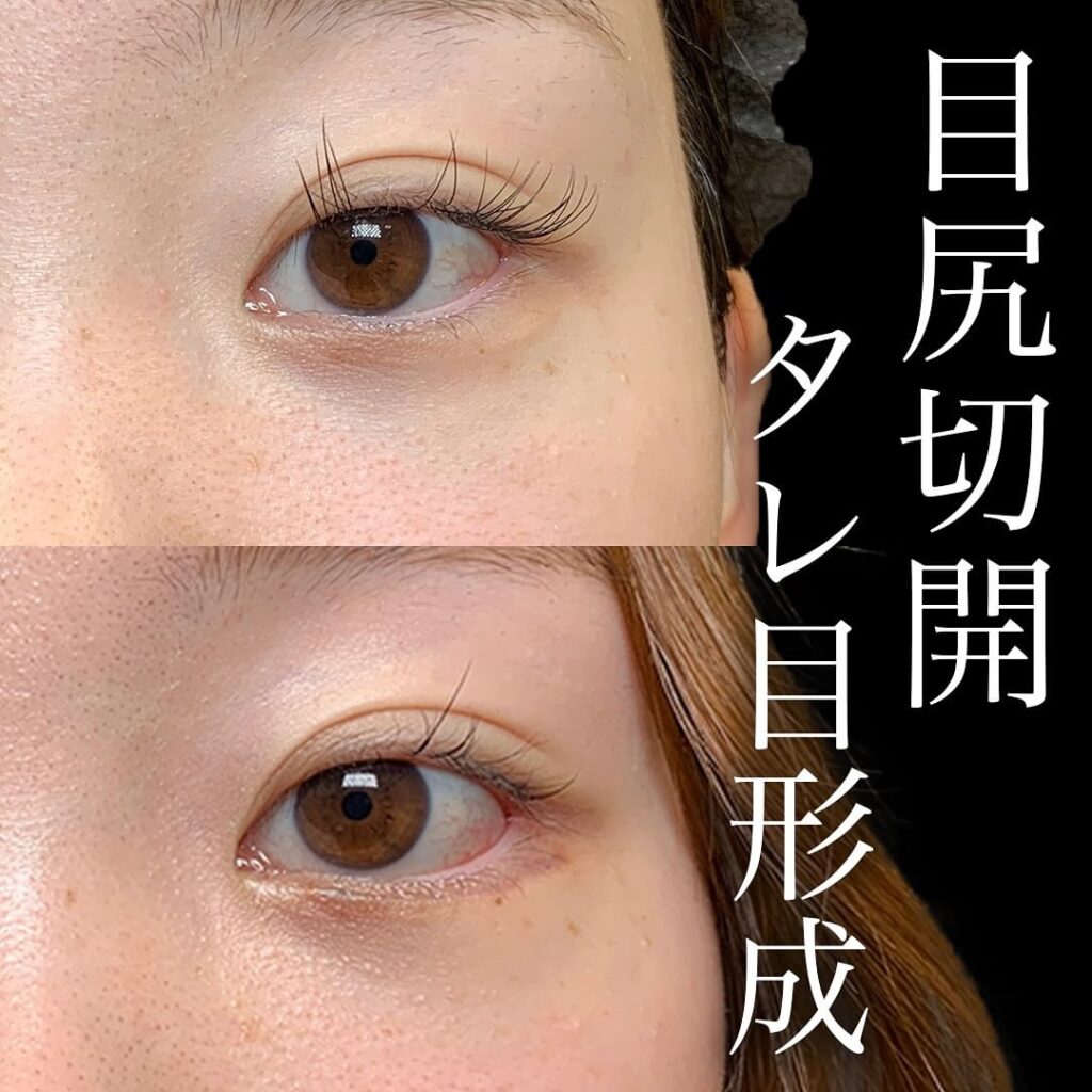 タレ目形成・グラマラスライン形成＋目尻切開の症例写真
（名医の円戸望医師が執刀）