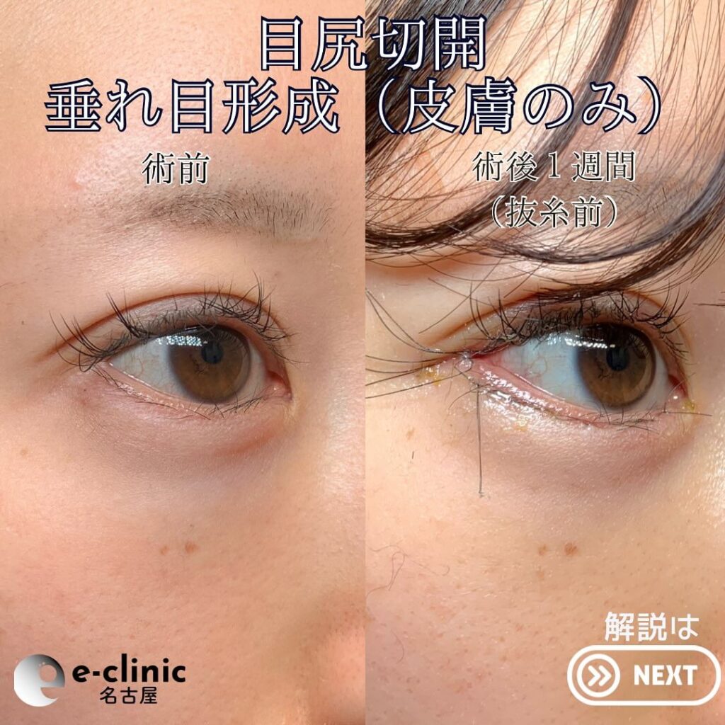 タレ目形成・グラマラスライン形成＋目尻切開の症例写真
（名医の円戸望医師が執刀）1