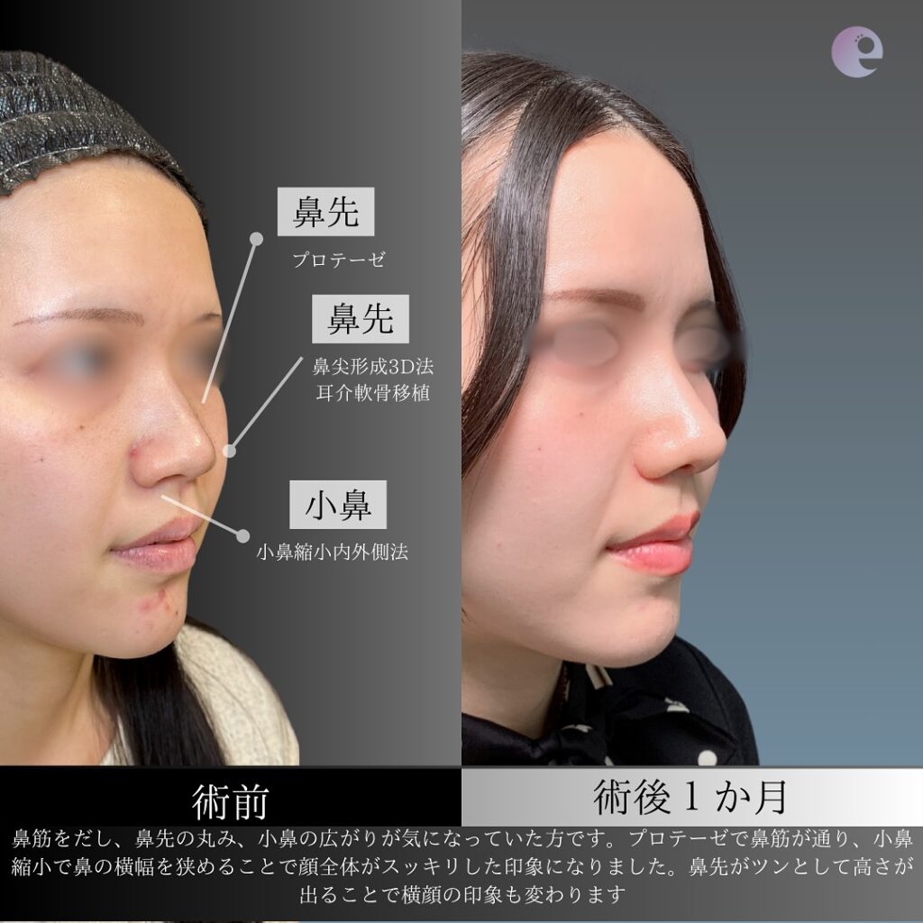 鼻のプロテーゼと鼻尖形成3Dと耳介軟骨移植と小鼻縮小内側法の症例写真 (3)