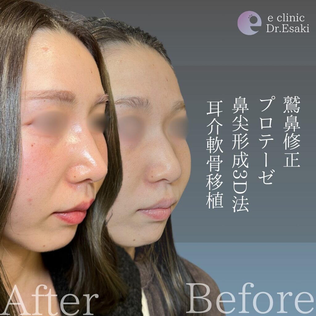 鷲鼻修正とプロテーゼと鼻尖形成３D法と耳介軟骨移植の症例写真 (1)
