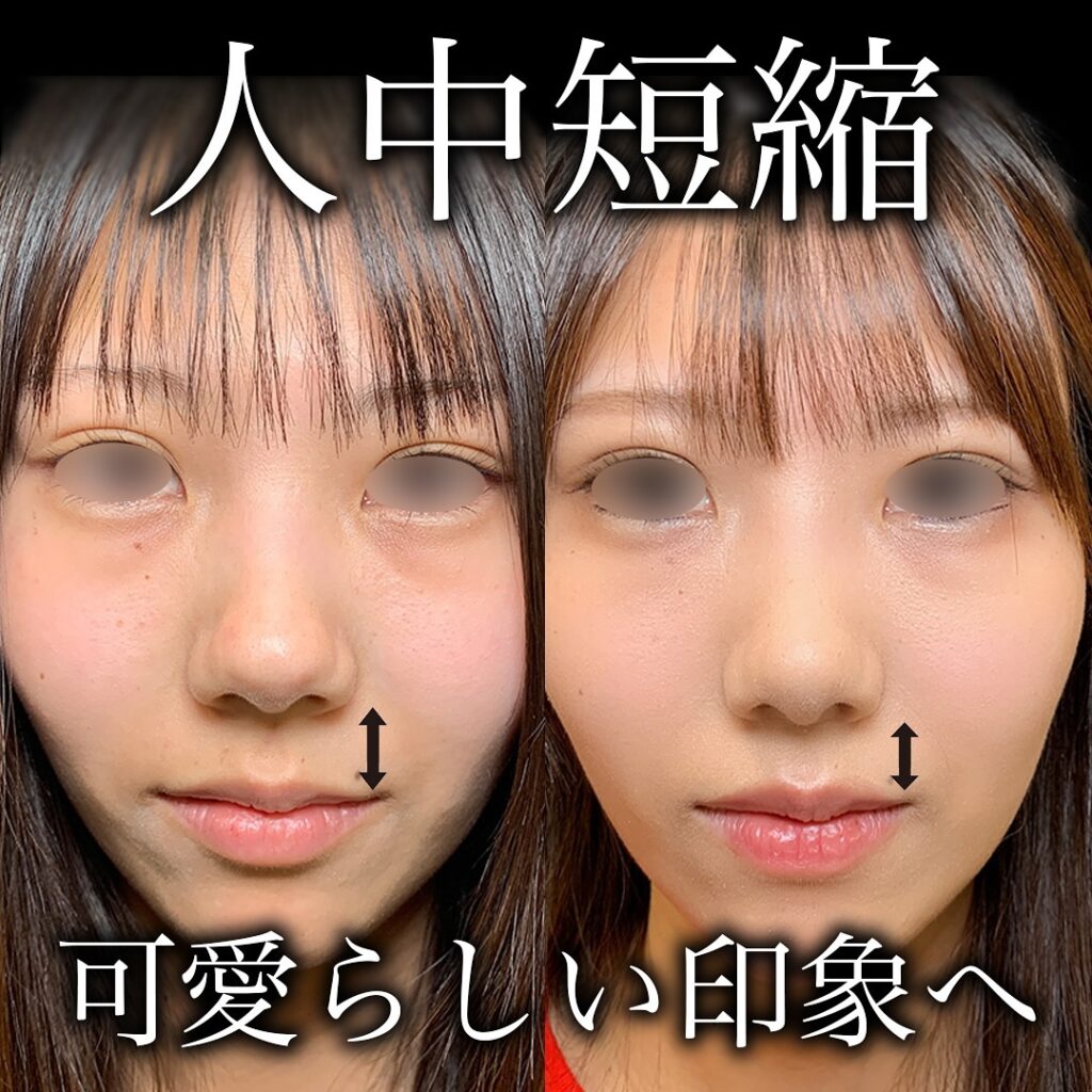 人中短縮の症例写真 (7)