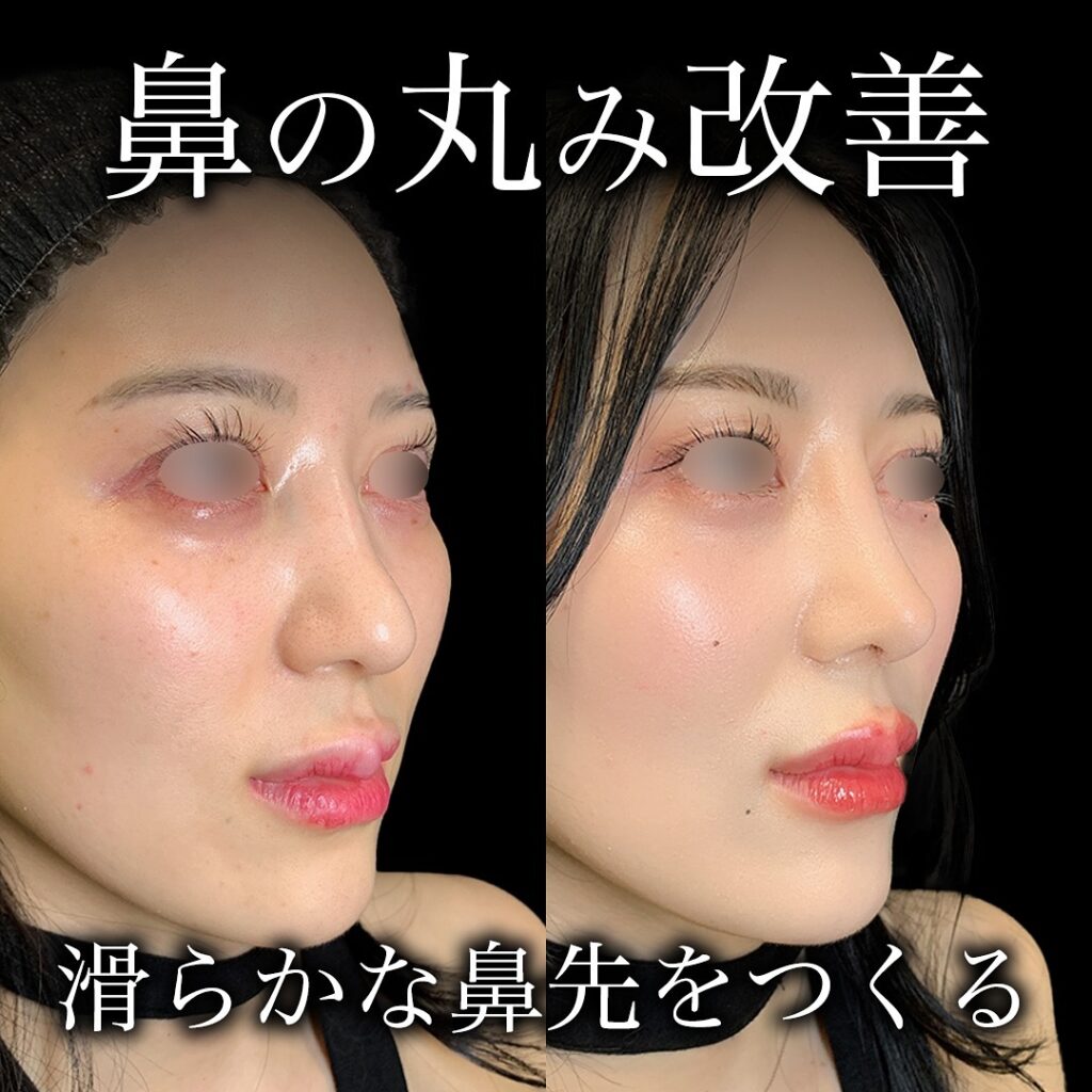 鼻尖形成と耳介軟骨移植の症例写真 (5)