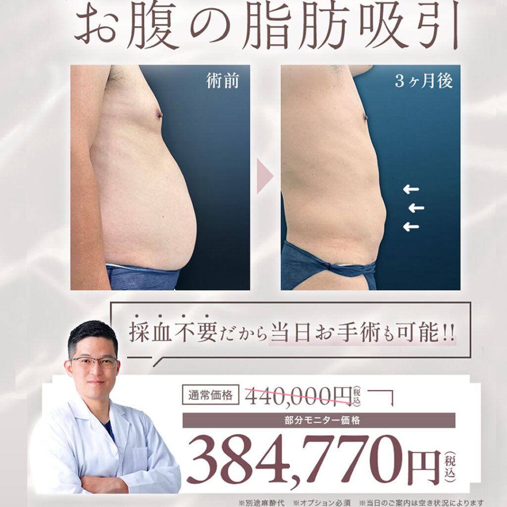 お腹の脂肪吸引のバナー