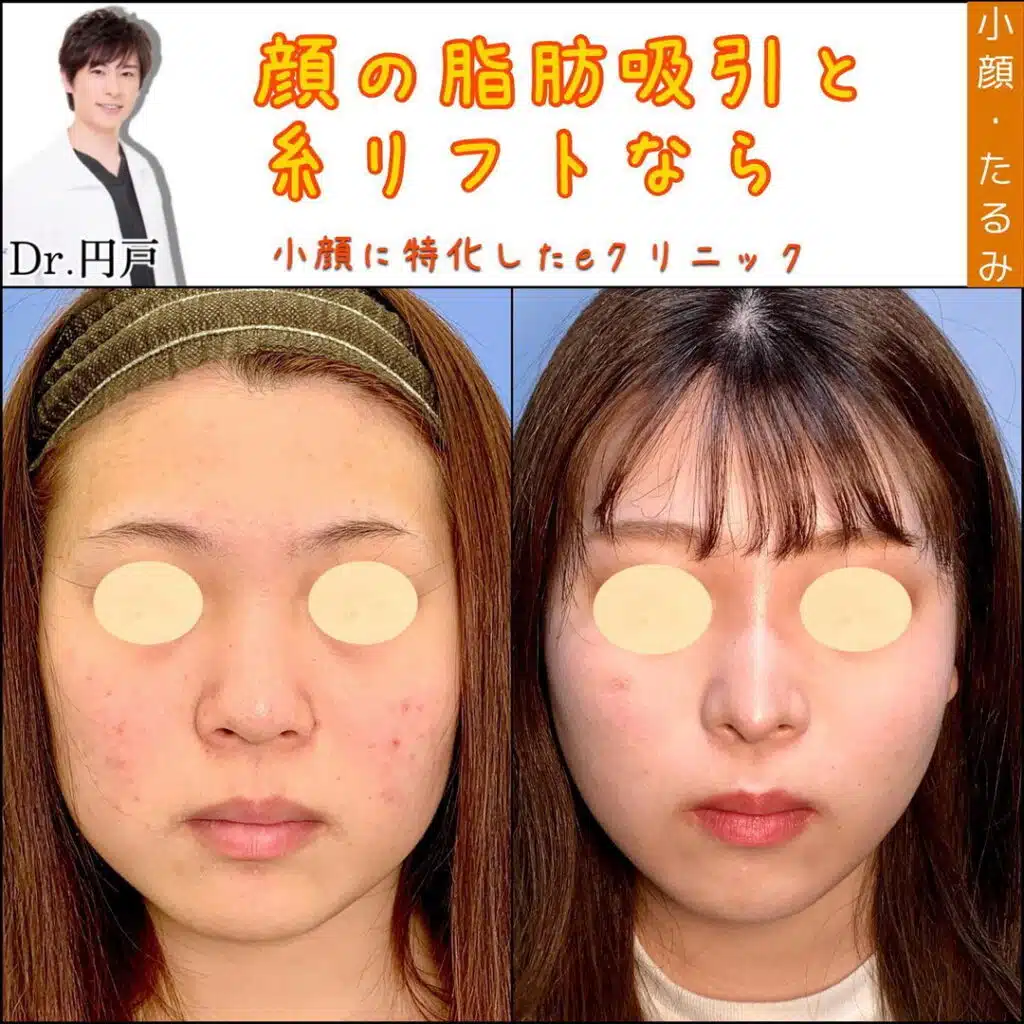 糸リフト 脂肪吸引