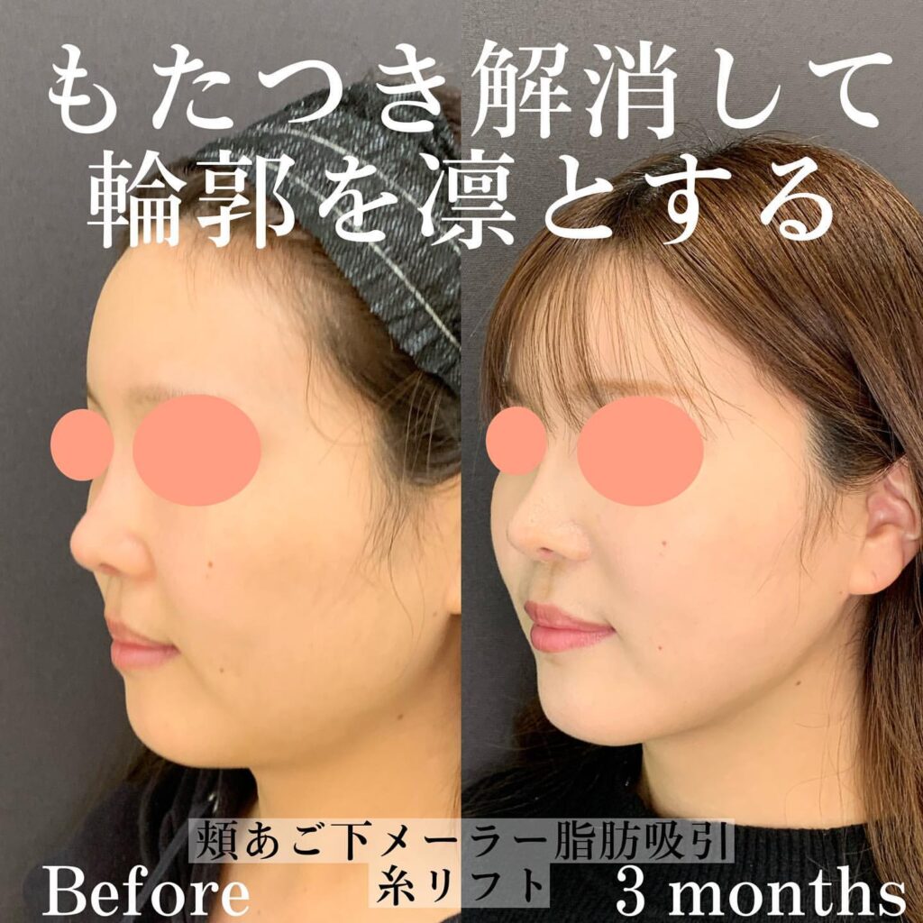 eclinic大阪梅田院の脂肪吸引症例写真
