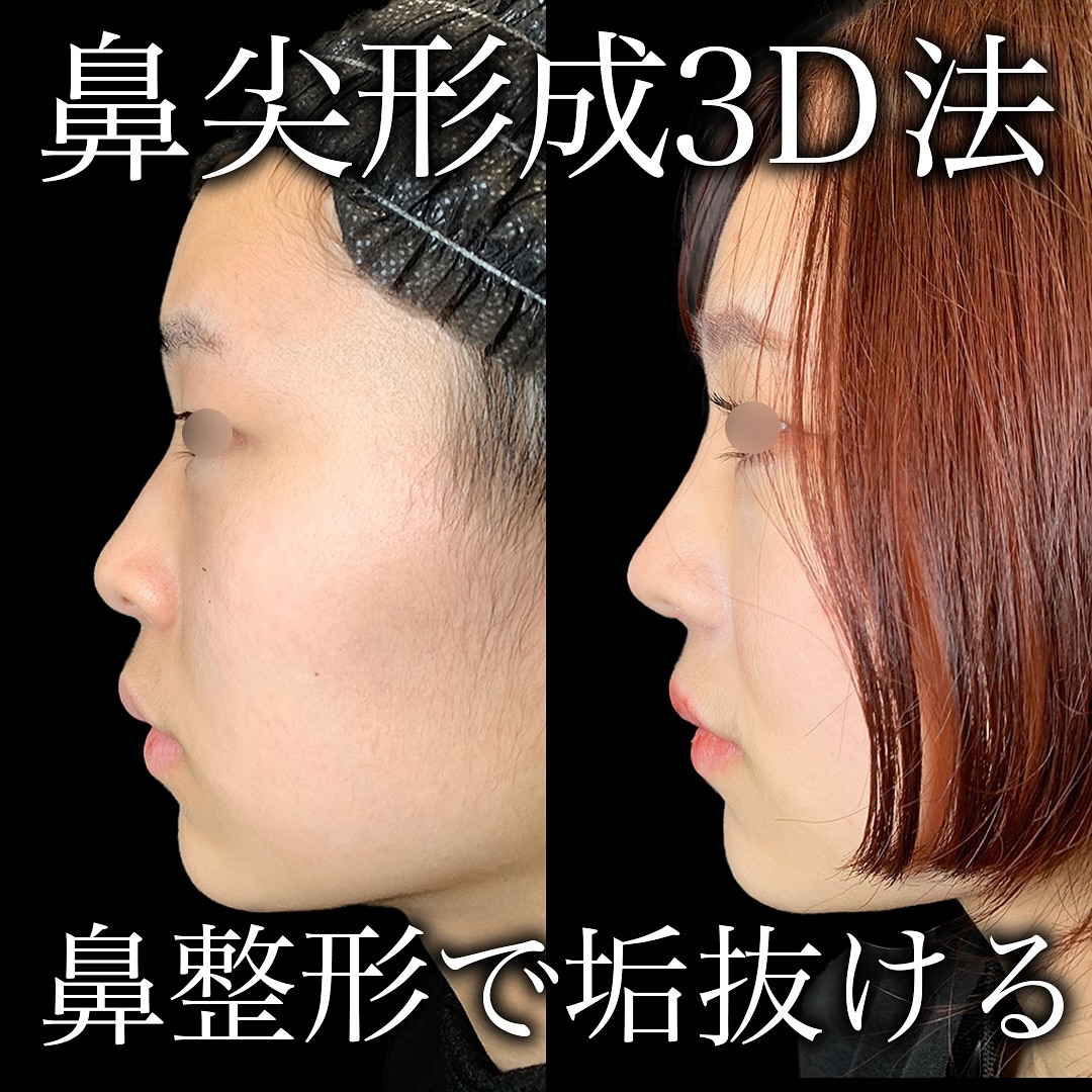 鼻尖形成3D法の症例写真