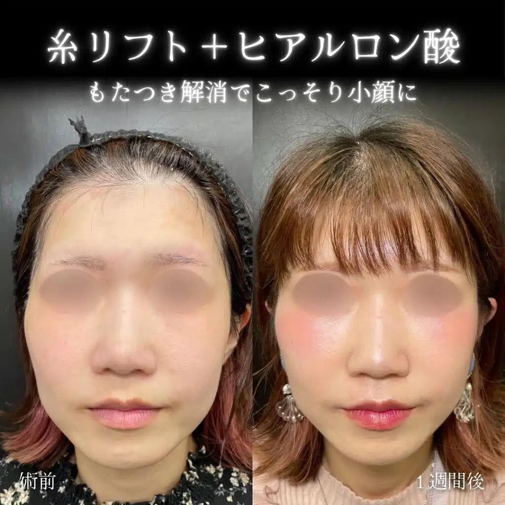 ヒアルロン酸