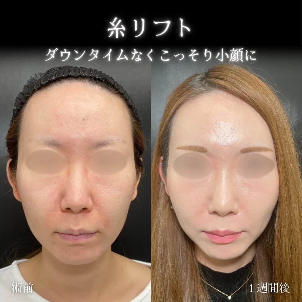 eclinic大阪梅田院の糸リフト症例写真