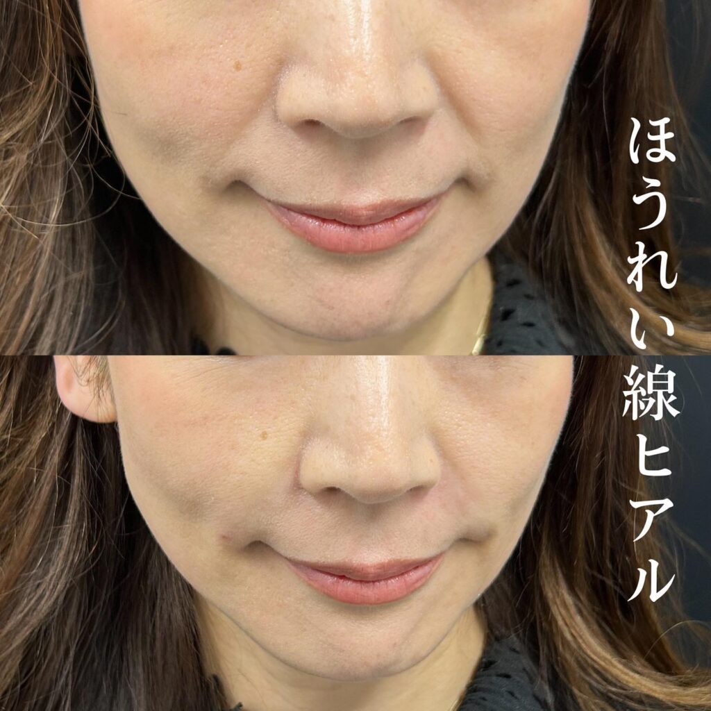 ほうれい線のヒアルロン酸の症例写真