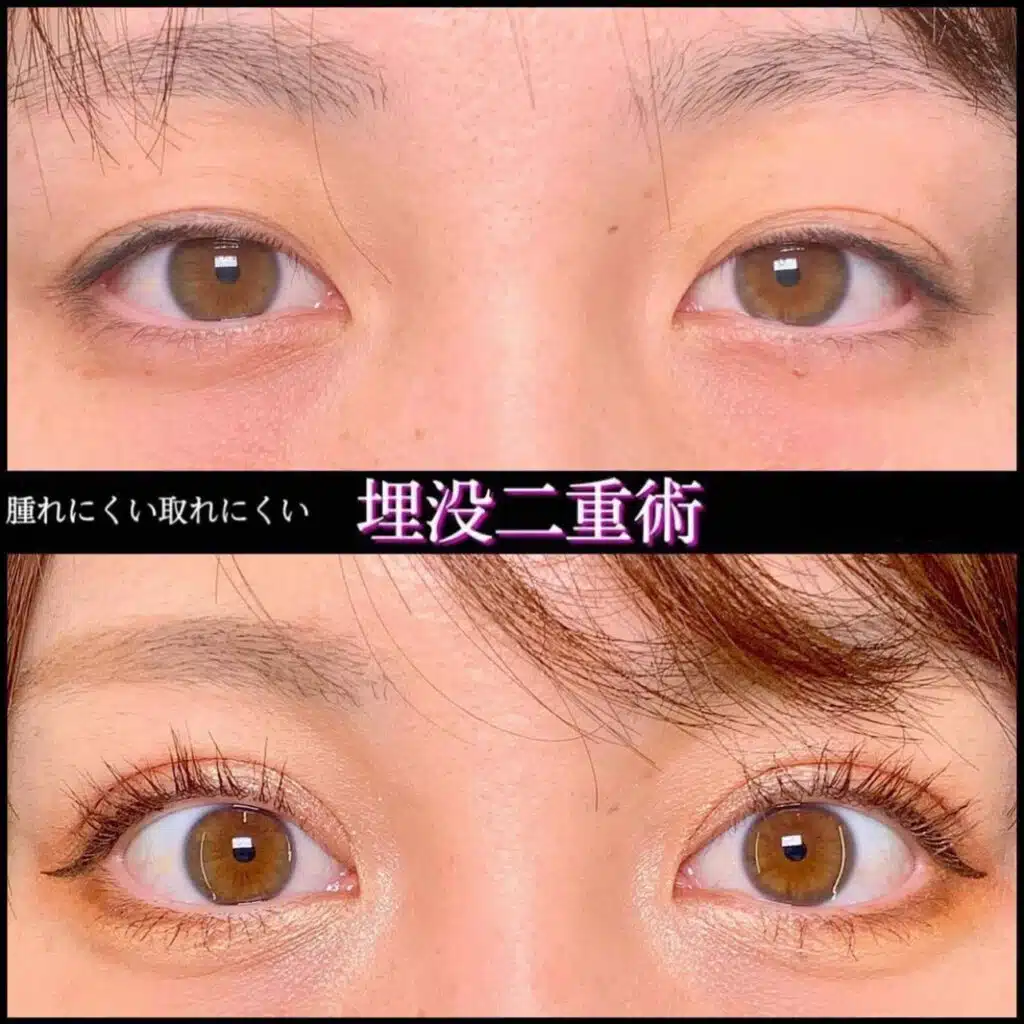 腫れにくい取れにくい　埋没二重術　大阪梅田