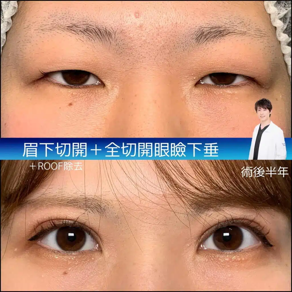 眉下切開　全切開眼瞼下垂　ROOF除去　大阪梅田