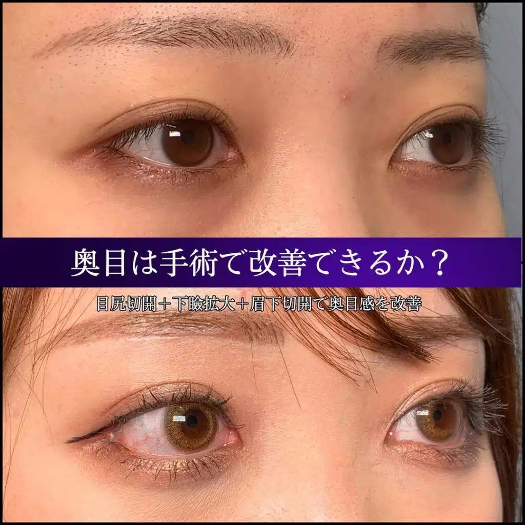 目尻切開　下瞼拡大　眉下切開　大阪梅田