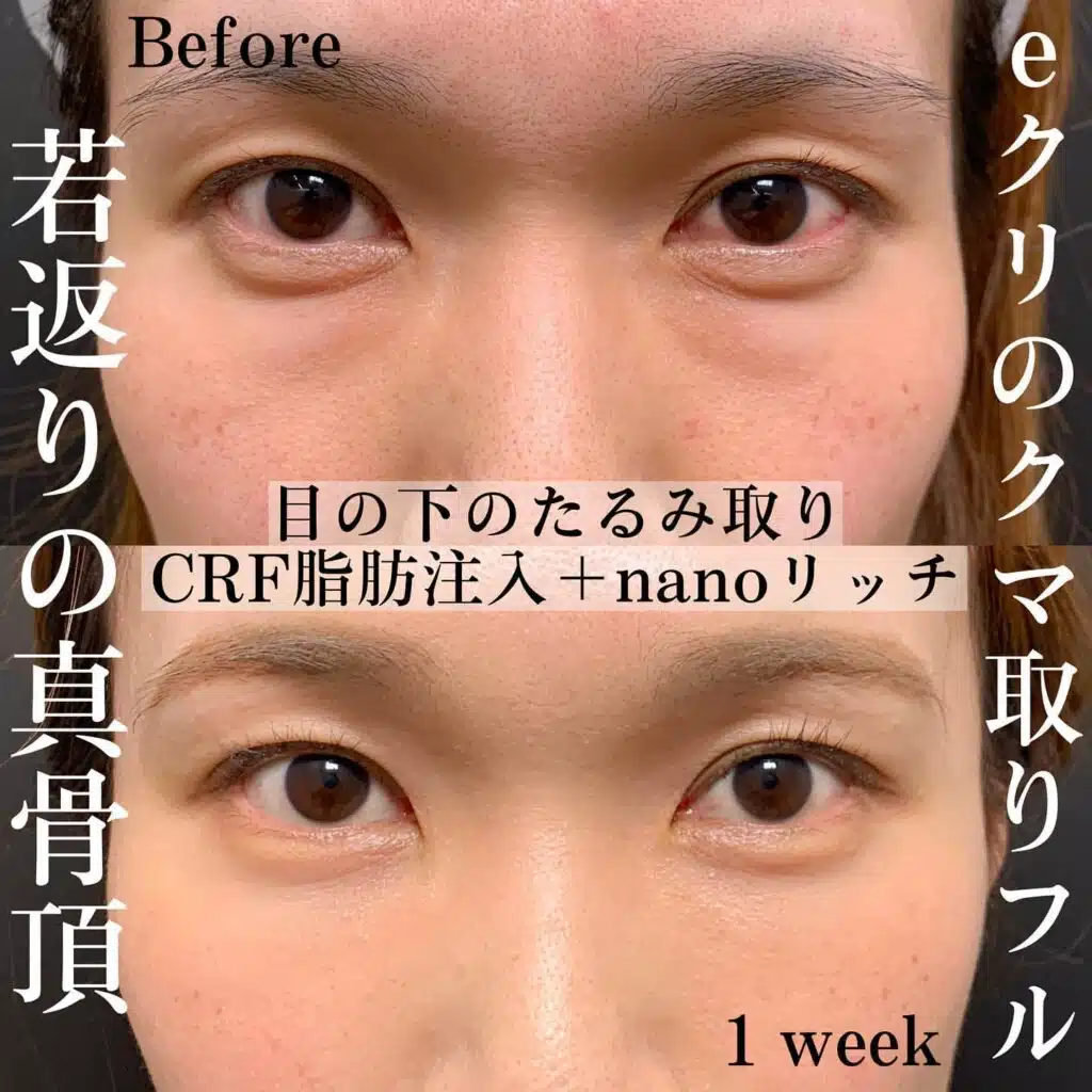 目の下のたるみ取り　CRF脂肪注入　nanoリッチ　大阪梅田