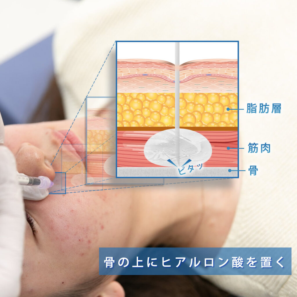ヒアルロン酸を骨膜上に注入している図解