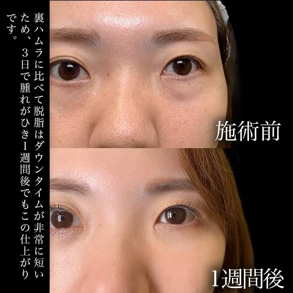 経結膜脱脂　大阪梅田