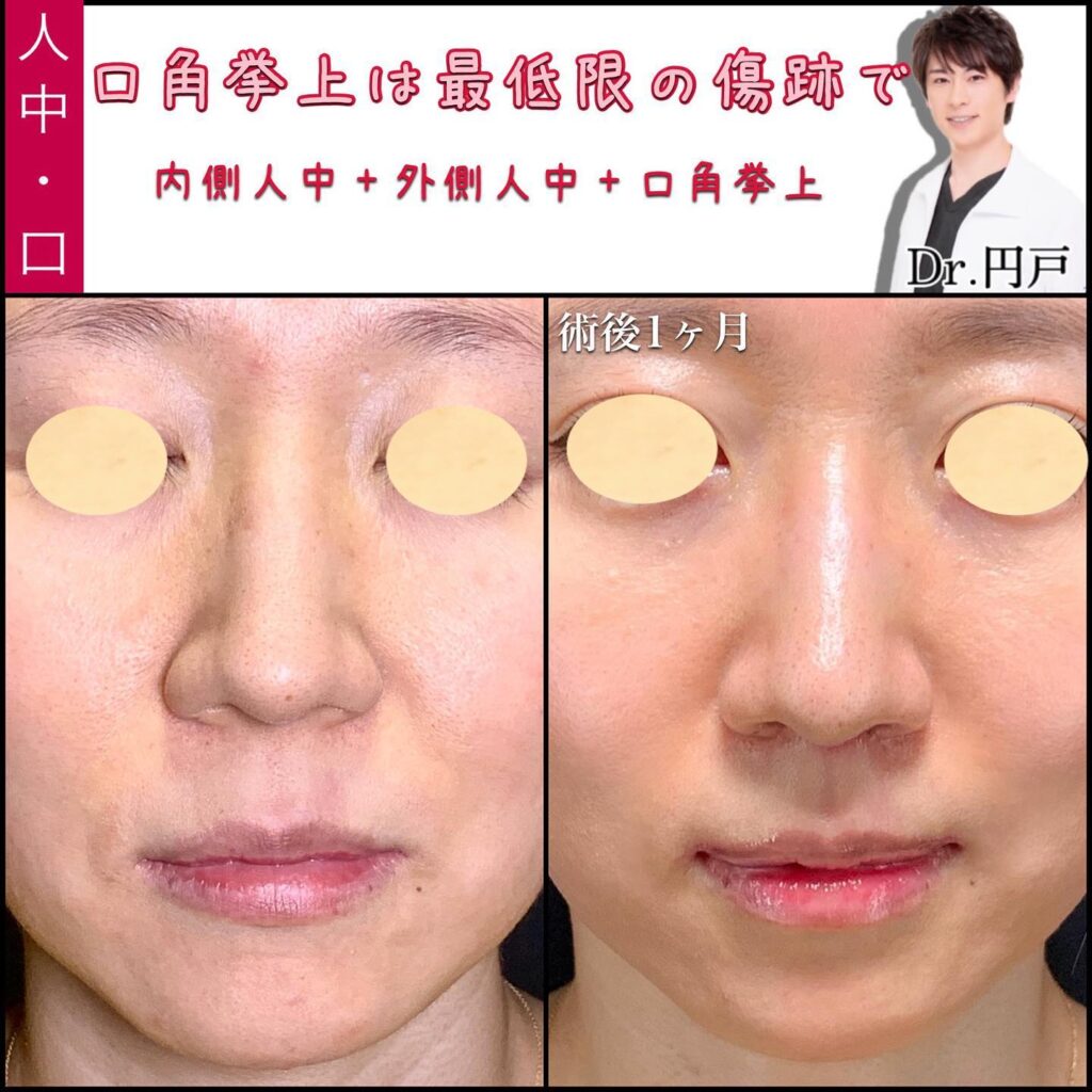 人中短縮と口角挙上の症例写真 (3)