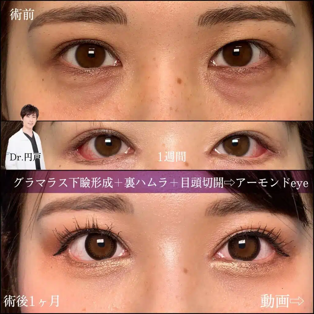 グラマラス下瞼形成　裏ハムラ　目頭切開　大阪梅田
