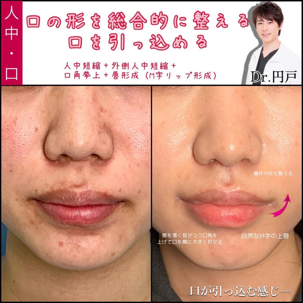 人中短縮と口角挙上とM字リップの症例写真 (3)
