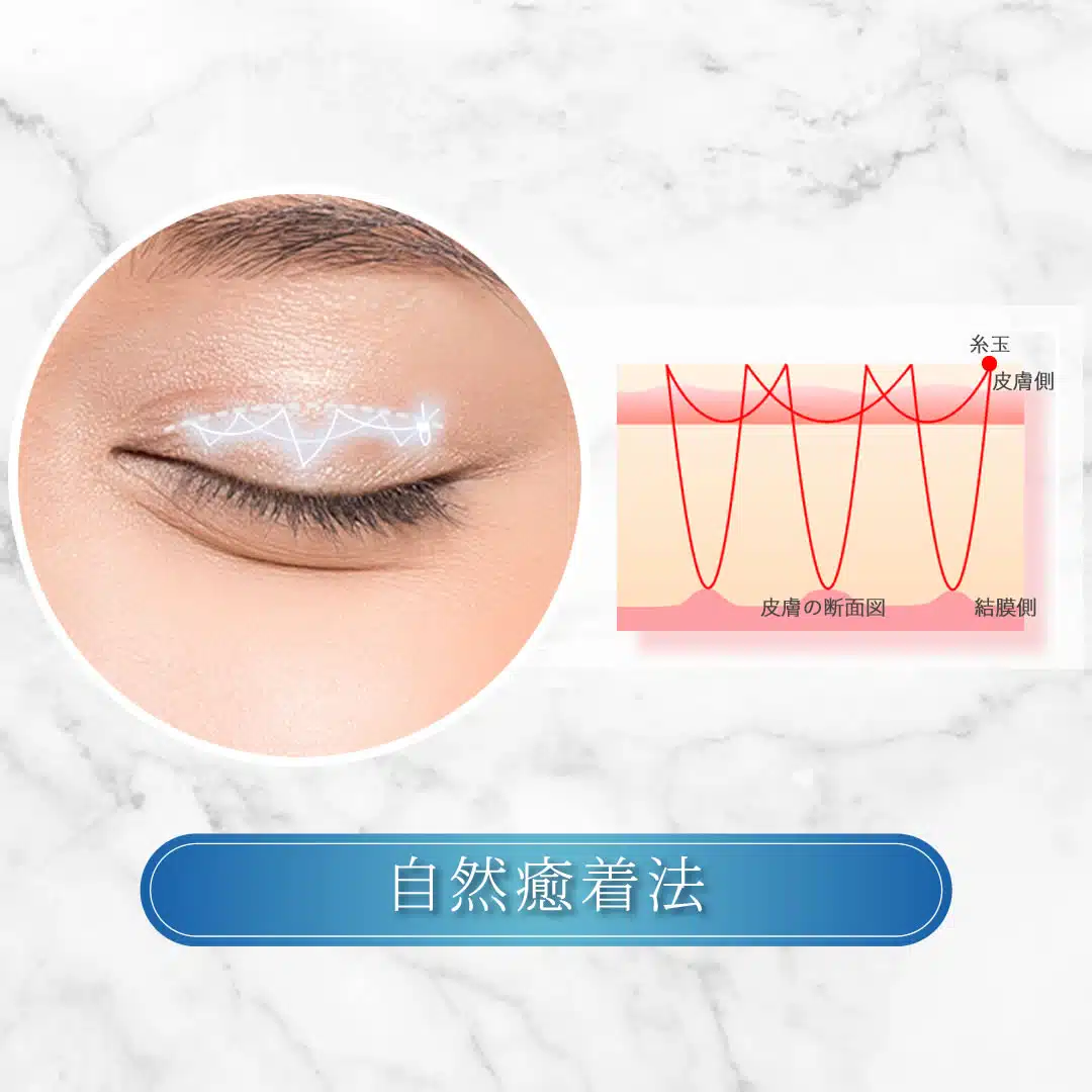 自然癒着法　大阪梅田