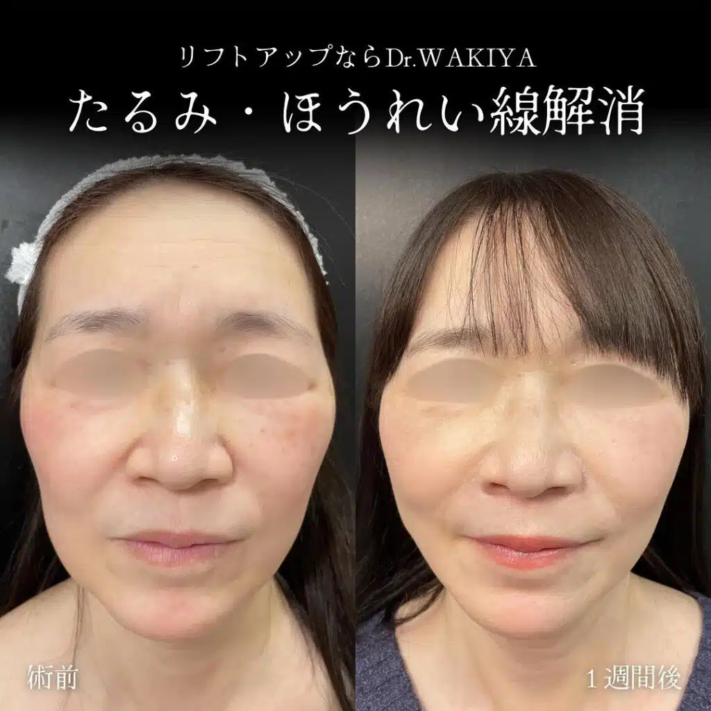 たるみ・ほうれい線解消　大阪梅田　