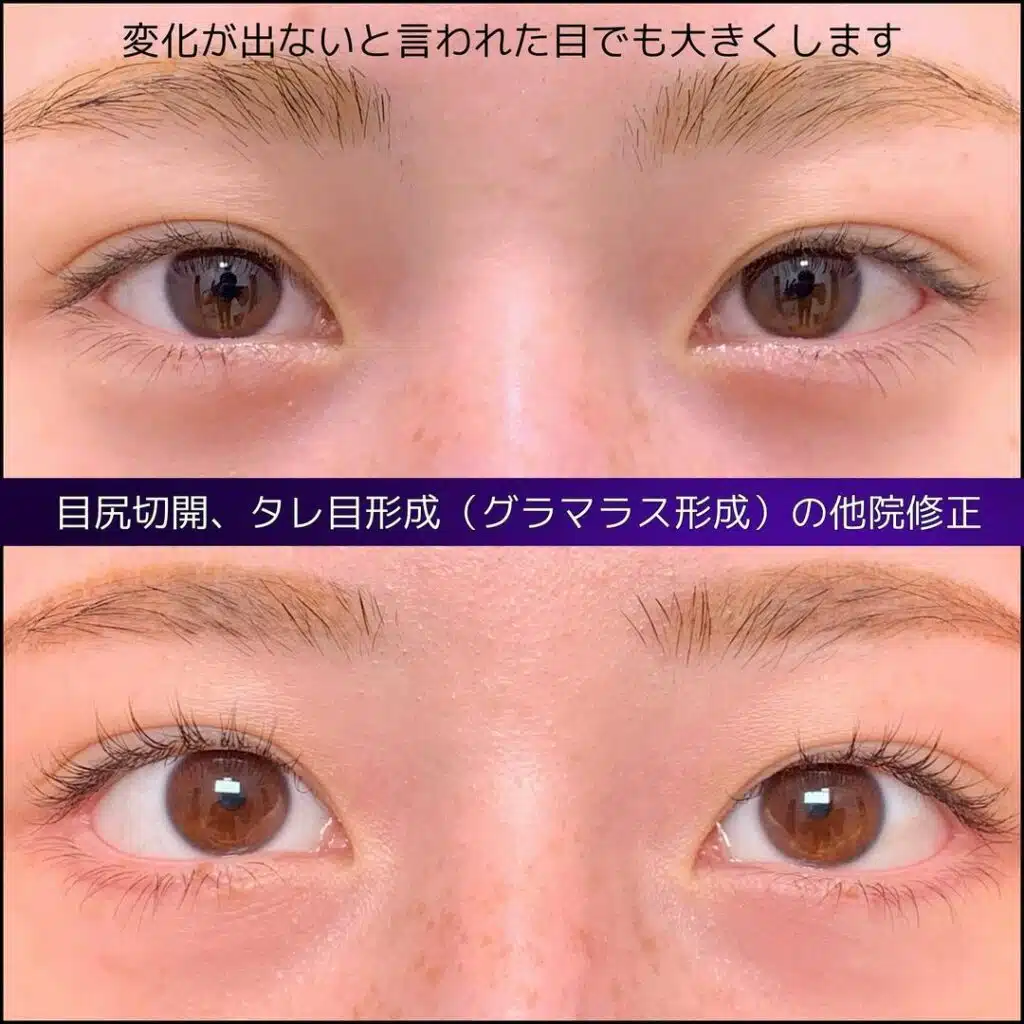 目尻切開　タレ目形成（グラマラス形成）　他院修正　大阪梅田