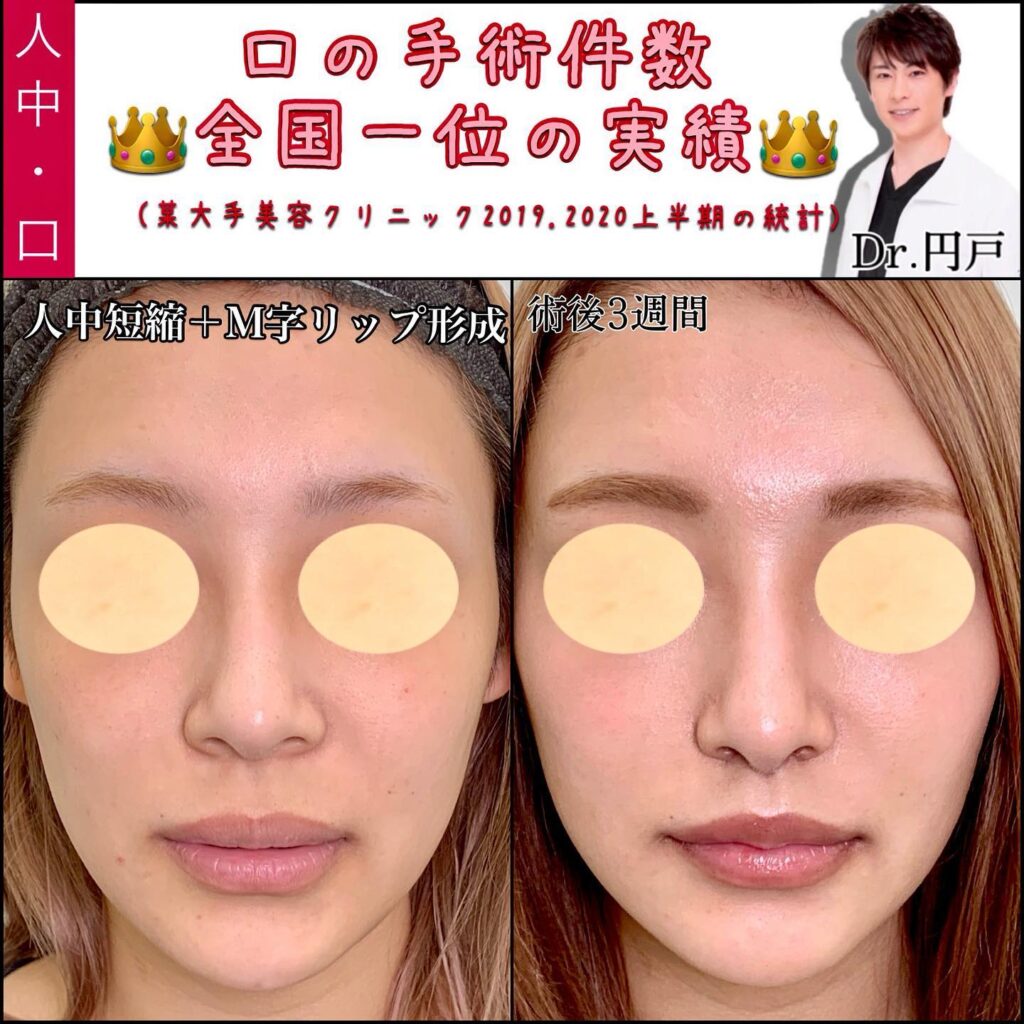 人中短縮とM字リップの症例写真 (3)