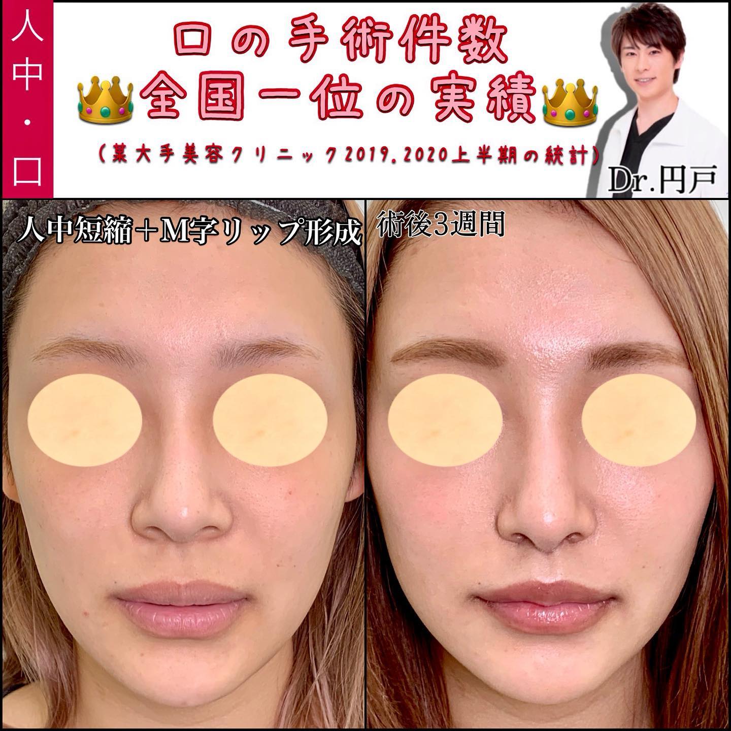 人中短縮とM字リップの症例写真 (3)