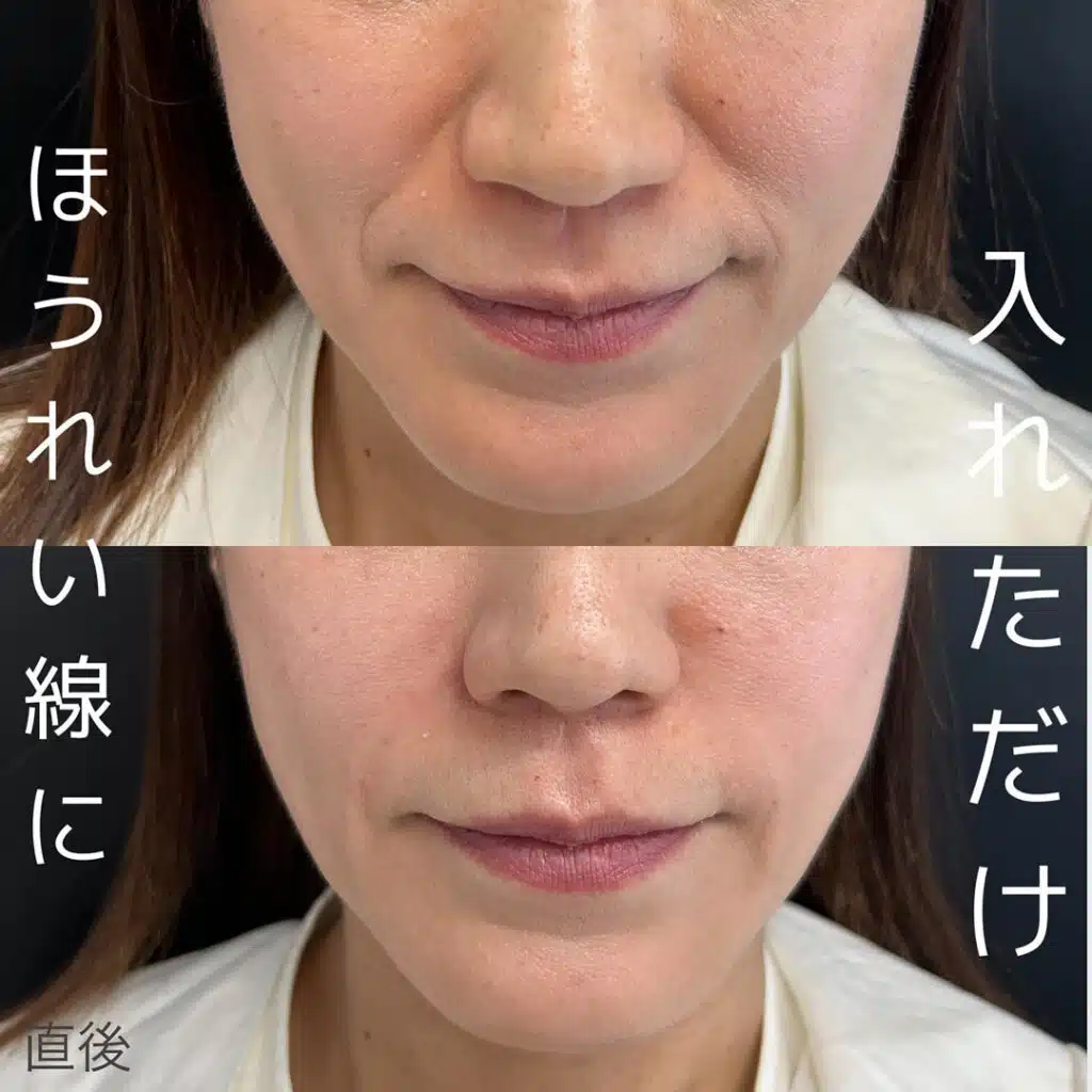 ほうれい線に入れただけ　大阪梅田　