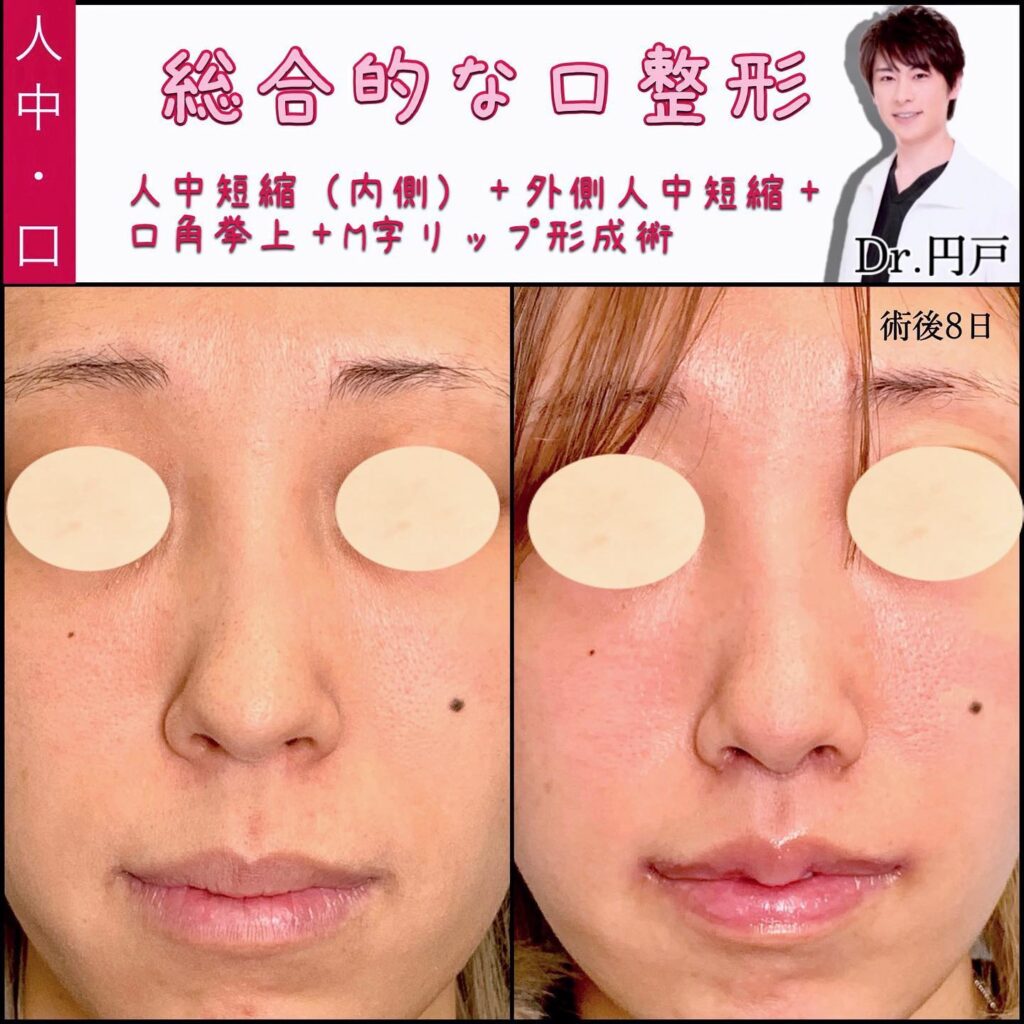 人中短縮と口角挙上とM字リップの症例写真