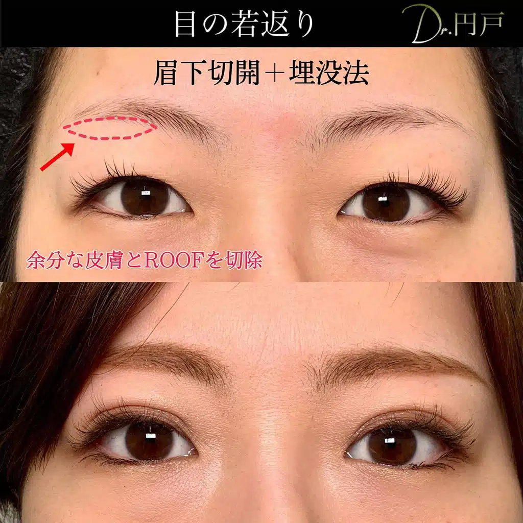 眉下切開　埋没法　大阪梅田