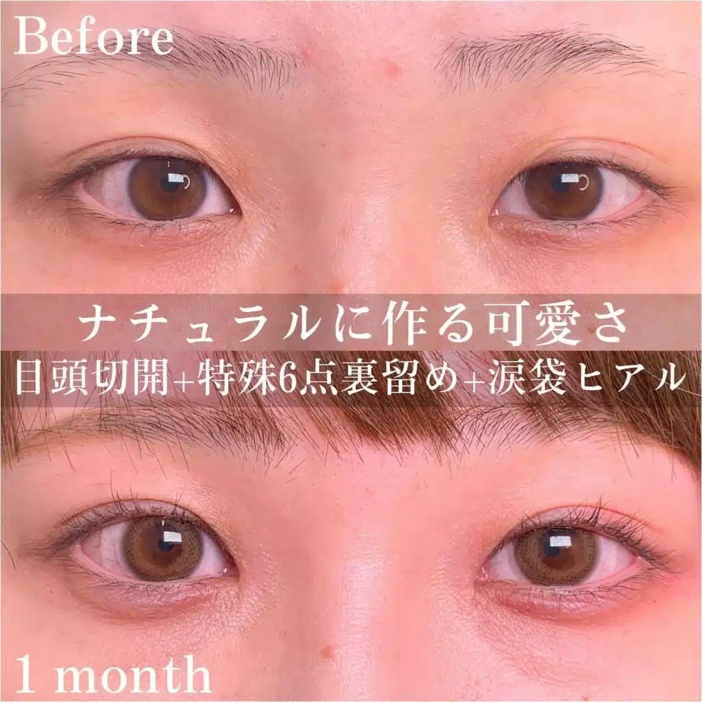 目頭切開　特殊6点裏留め　涙袋ヒアル　大阪梅田