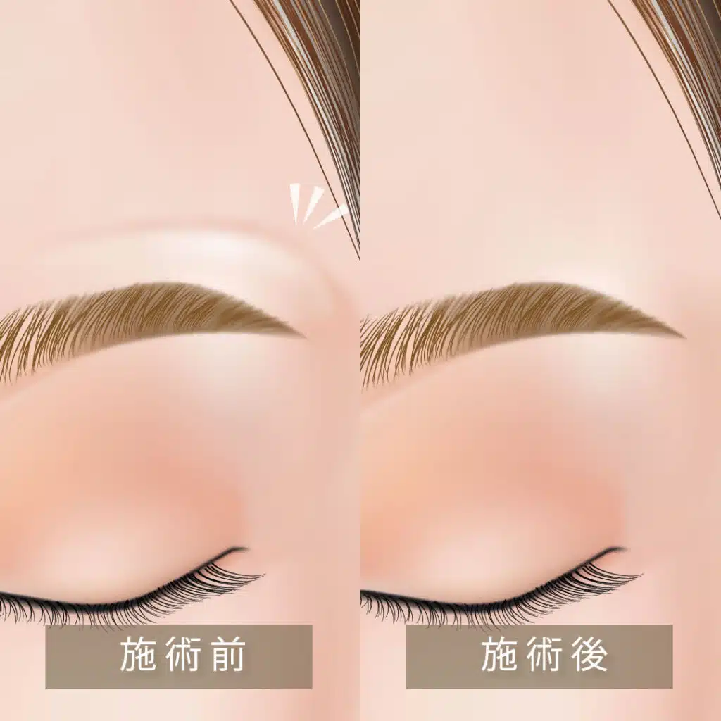 眉上ボトックス　大阪梅田
