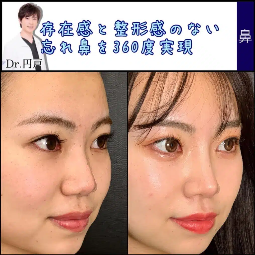 小鼻縮小　大阪梅田