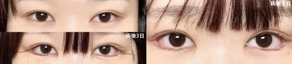 白目の露出を広げるデザイン　大阪梅田