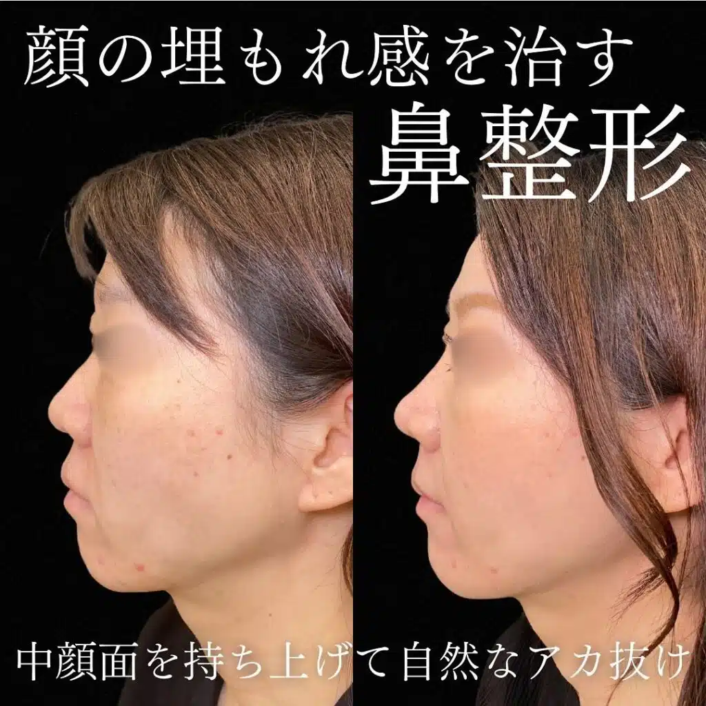 鼻尖形成クローズ法と耳軟骨移植と鼻プロテーゼと小鼻縮小と猫貴族と人工真皮と人中短縮術と糸リフトの症例写真　大阪梅田