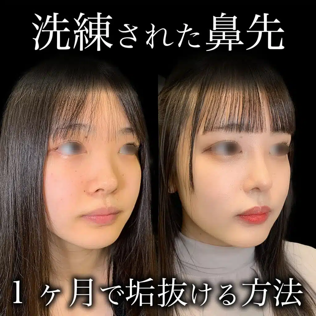 鼻のプロテーゼと鼻尖形成と耳介軟骨移植の症例写真　大阪梅田