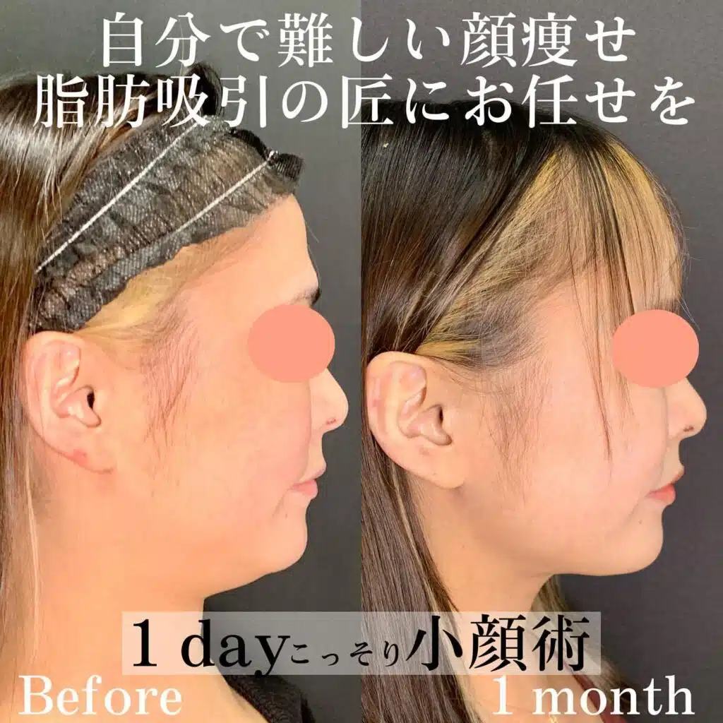小顔脂肪吸引　大阪梅田
