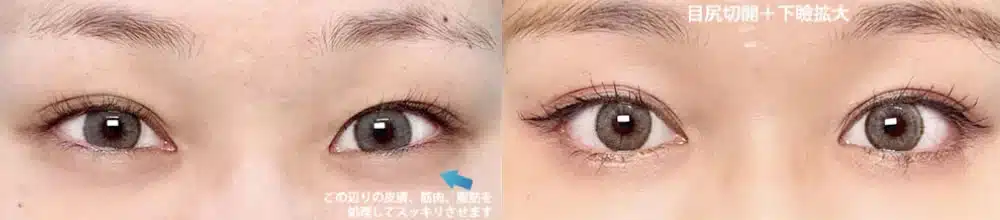 つり⽬を⾃然なアーモンド型に整えるデザイン　大阪梅田