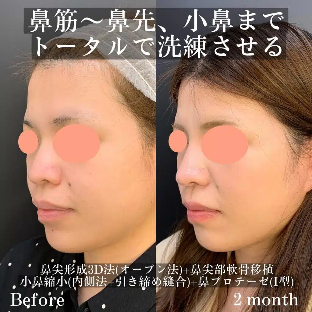 鼻尖形成3D法（オープン法）+鼻尖部軟骨移植+小鼻縮小（内側法+引き締め縫合）+鼻プロテーゼ（Ⅰ型）　大阪梅田