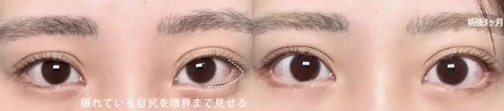 目尻側の白目の露出を増やすデザイン　大阪梅田