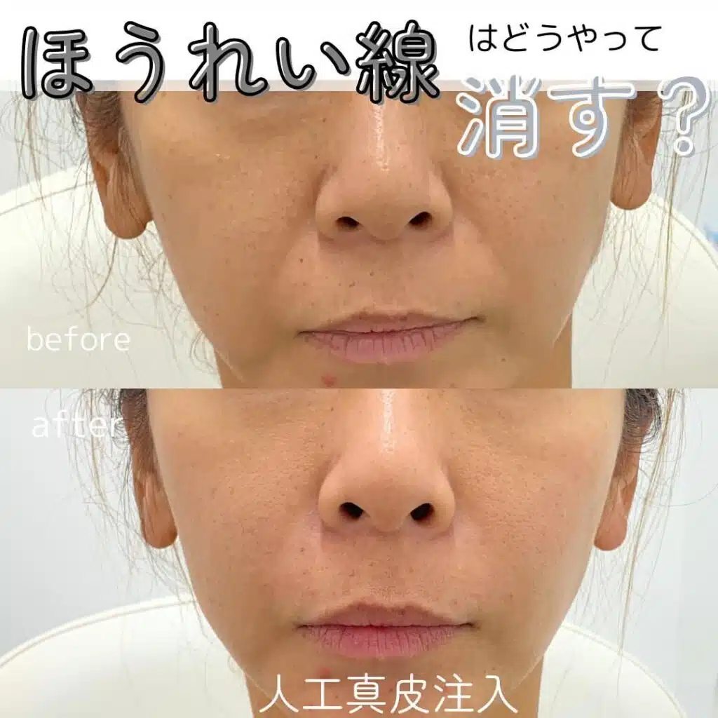 人工真皮注入　大阪梅田