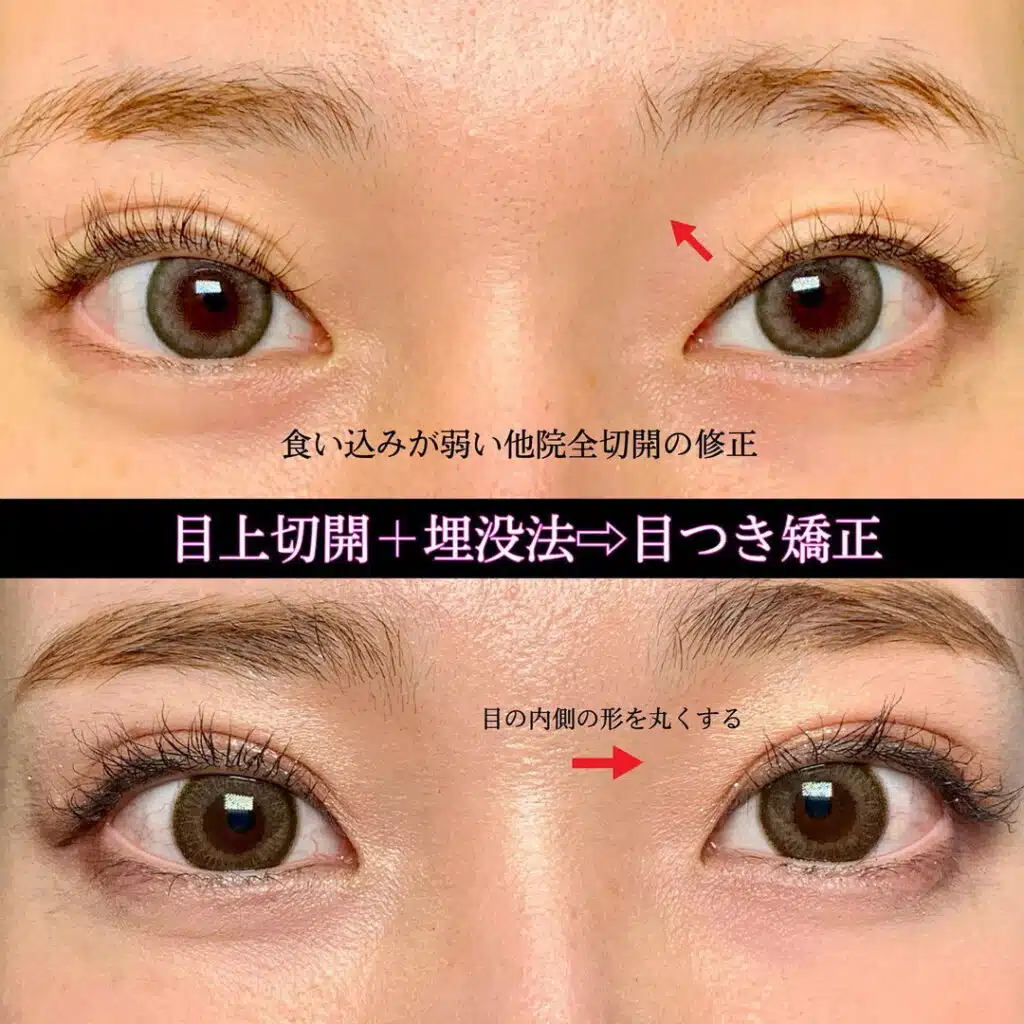 目上切開+埋没法　大阪梅田