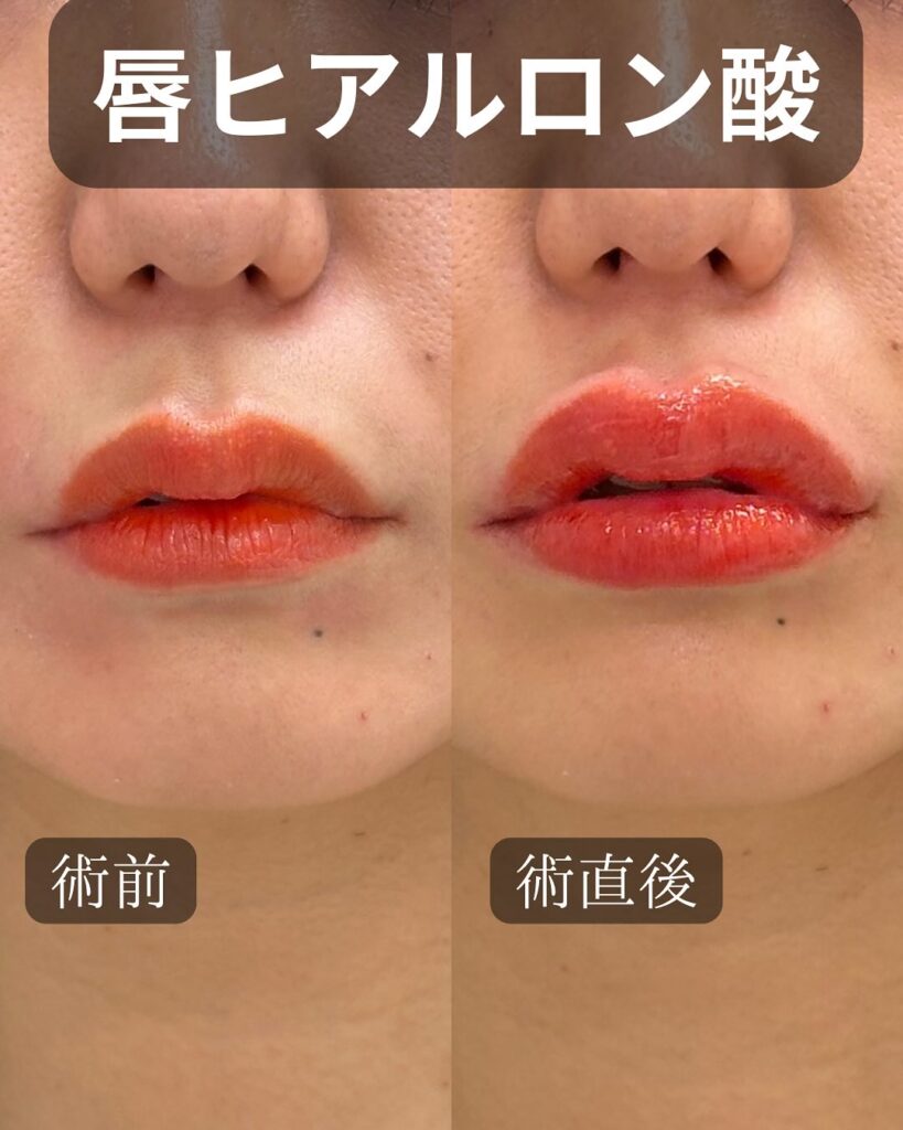 唇のヒアルロン酸の症例写真