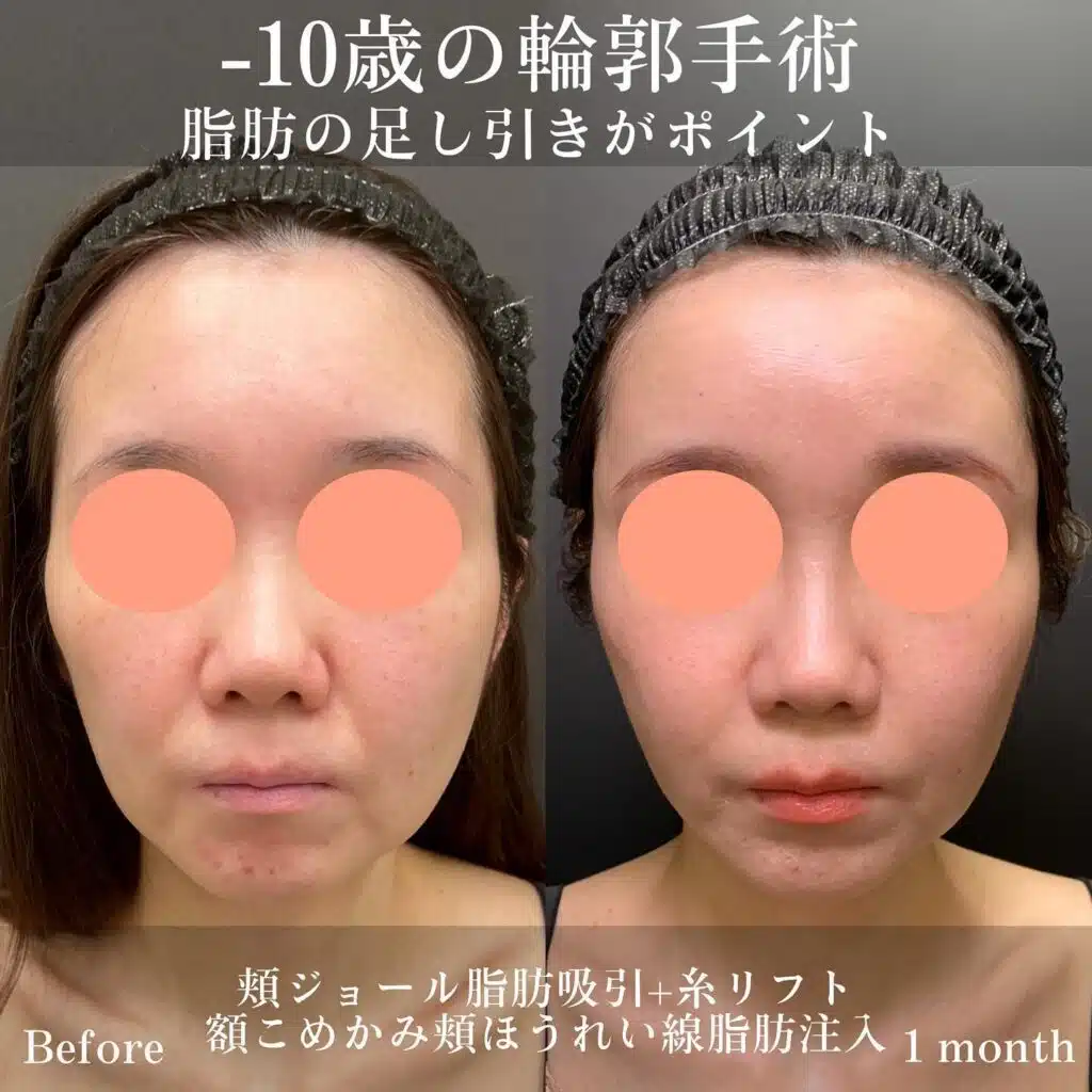 頬ジョール脂肪吸引+糸リフト　額こめかみ頬ほうれい線脂肪注入　大阪梅田